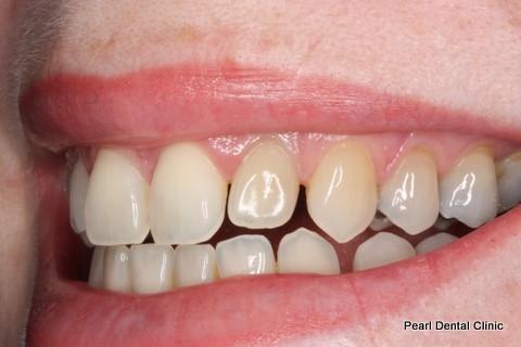 Teeth Gap Before After - Left top/bottom teeth
